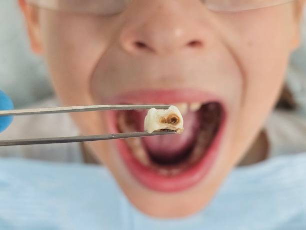 Best Dentist for Tooth Abscess  in Waurika, OK